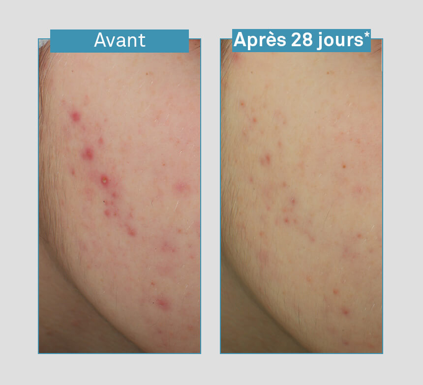 ser-anti-imperfecțiuni
