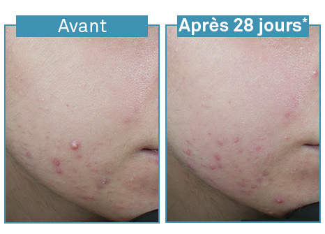 Rezultate Luxéol Ser antiimperfecțiuni